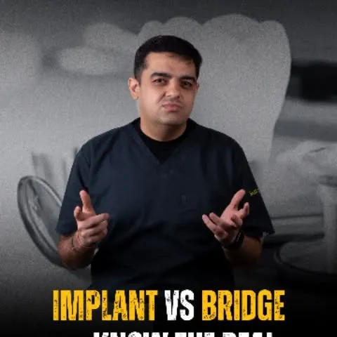 Implant or bridge — both replace missing teeth.
The real difference is how much of your natural teeth are preserved.
The right choice always depends on your condition

#DentalImplants
#DentalBridge
#ToothReplacement
#Prosthodontics
#conservativedentistryresident